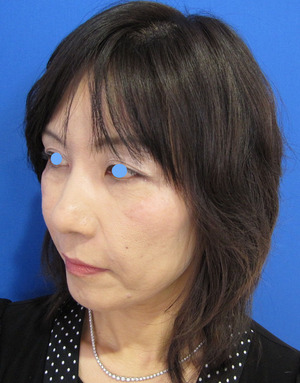 目の下のたるみ、目のくまでお悩みの方、切らずに完璧に解決します。TCB-R法　手術直後　症例写真